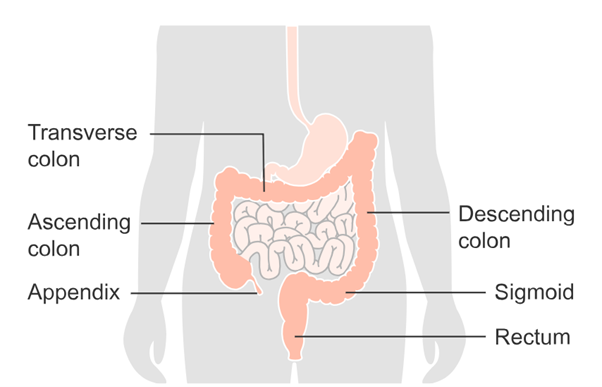 Colorectal Colorectal cancer