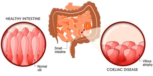 Coeliac Awareness Day