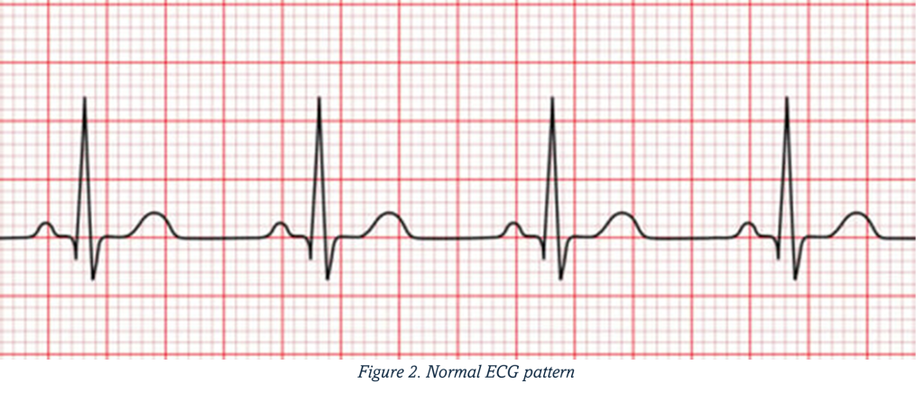 ECG Tests - Arrhytmias